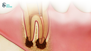Viêm tủy răng: Nguyên nhân, triệu chứng, cách điều trị hiệu quả 2 Viêm tủy răng: Nguyên nhân, triệu chứng, cách điều trị hiệu quả