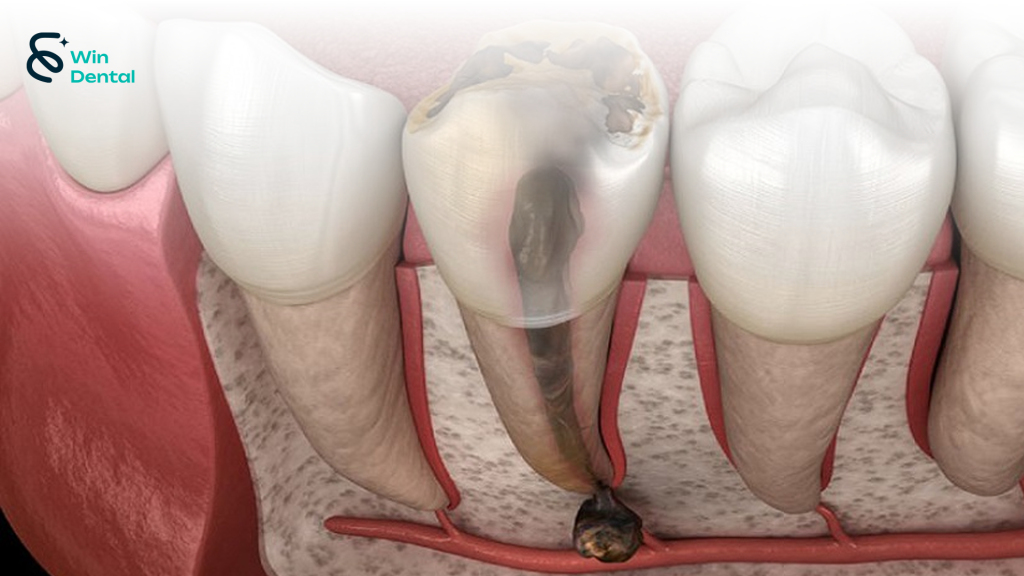 Viêm tủy răng: Nguyên nhân, triệu chứng, cách điều trị hiệu quả 1 viem tuy 2