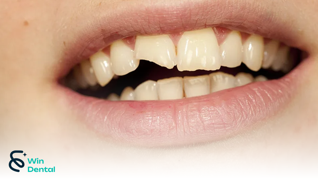 Răng nứt, mẻ, gãy: Nguyên nhân, triệu chứng và cách điều trị hiệu quả 1 win 1