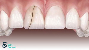 Răng nứt, mẻ, gãy: Nguyên nhân, triệu chứng và cách điều trị hiệu quả 2 Răng nứt thường xuất hiện dưới dạng các vết nứt nhỏ trên thân răng